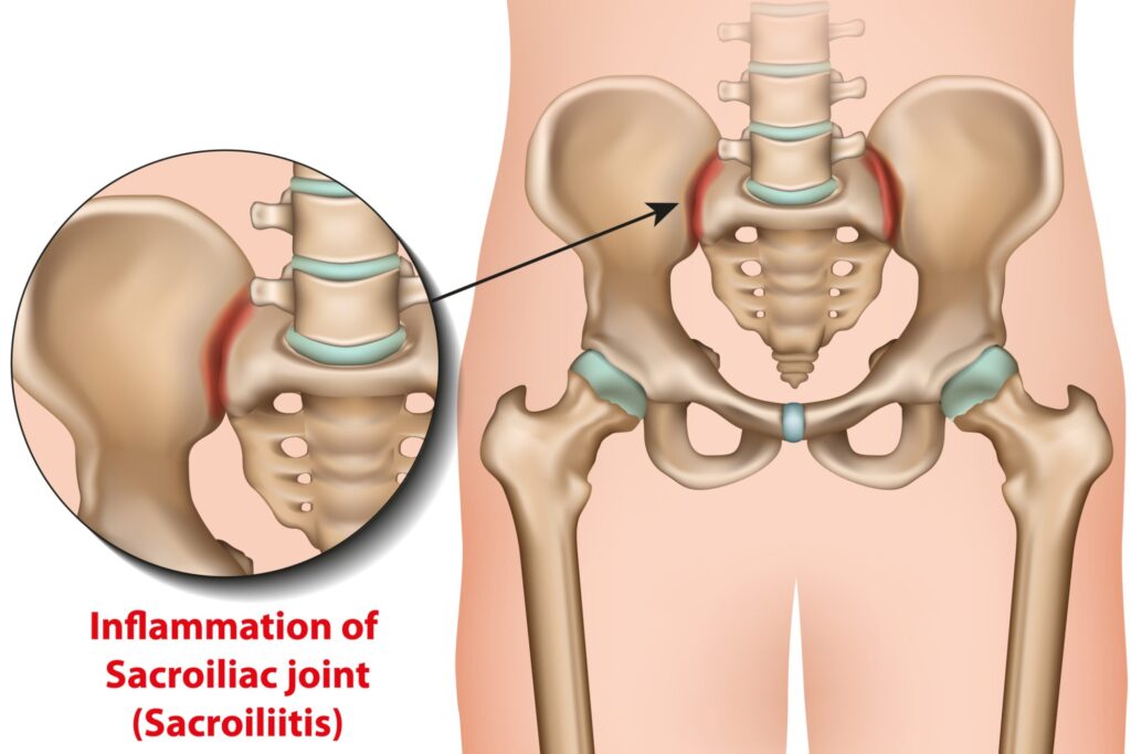 Sacroilliac joint